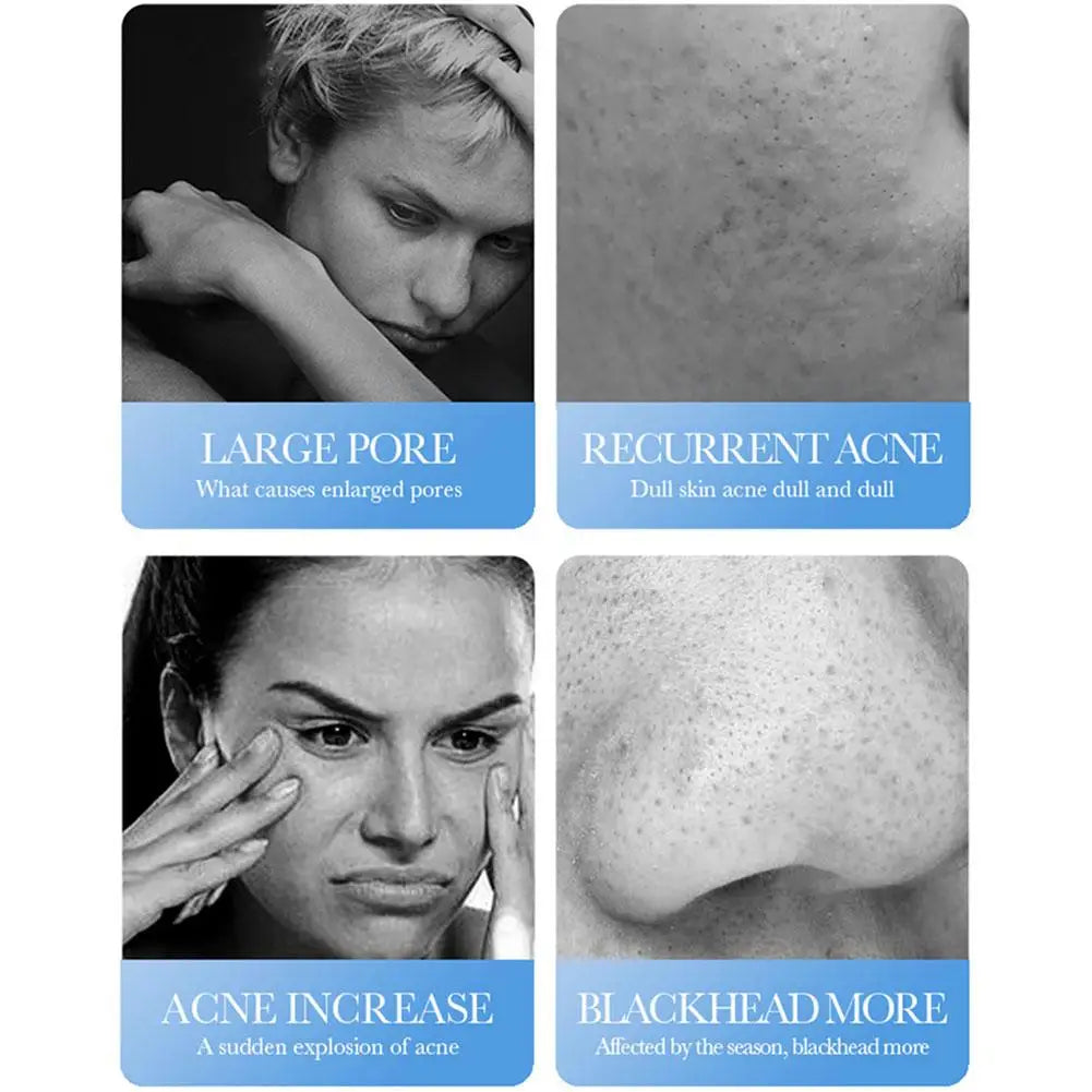 BIOAQUA Salicylic Acid Face Cream Acne Treatment Scar Mark Repair Moisturizing Blackhead Remover Facial Cleanser Skin Care