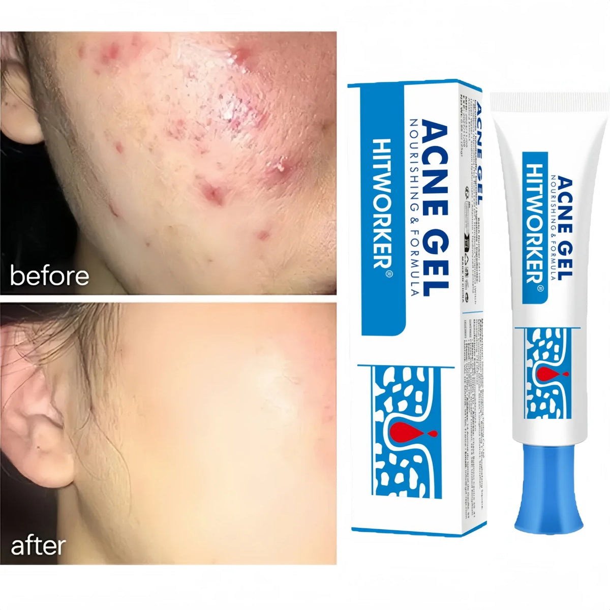 Salicylic Acid Acne Removal Cream Anti-Acne Repair Redness Pimple Spots Deep Cleaning Pore Oil Control Moisturizing Skin Care