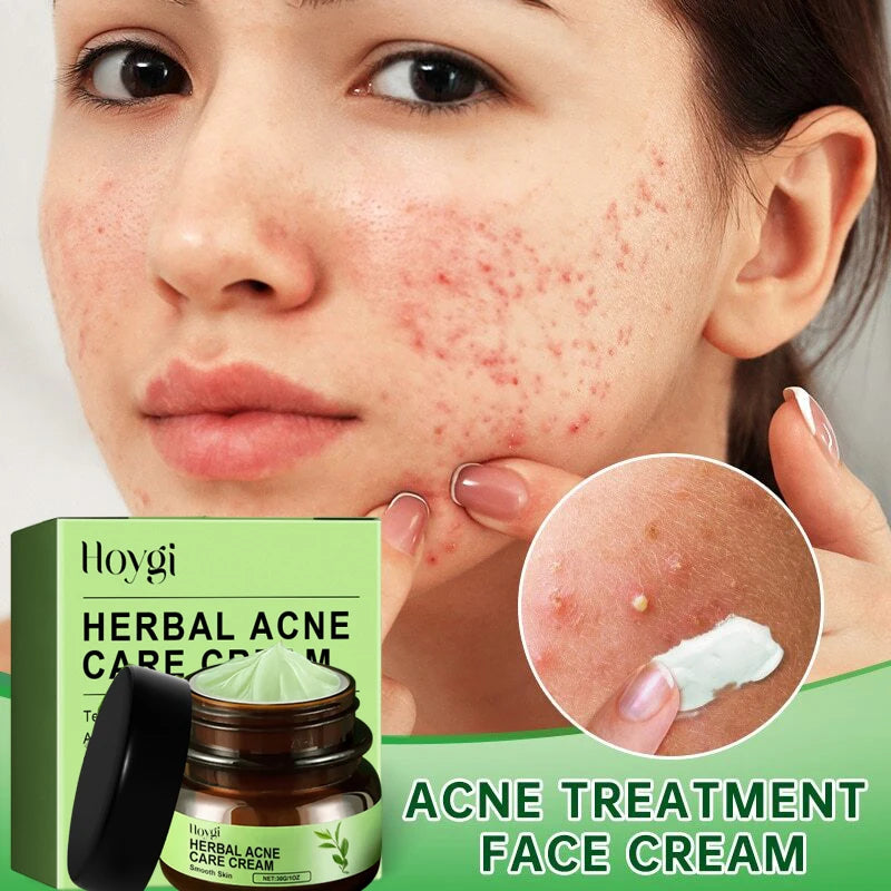 Acne Face Cream Pimple Treatment Oil Control Repair Redness Remove Blackhead Smooth Hydrating Moisturizing Pore Shrinking Serum